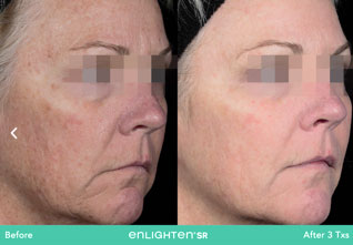 Taches pigmentaires traitées au laser Enlighten. Florence MAGAND-NOWAK Dermatologue-Annecy 74